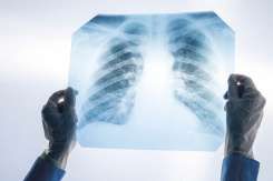 Screening pulmonar gratuit la Chișinău, pe 19 și 20 octombrie