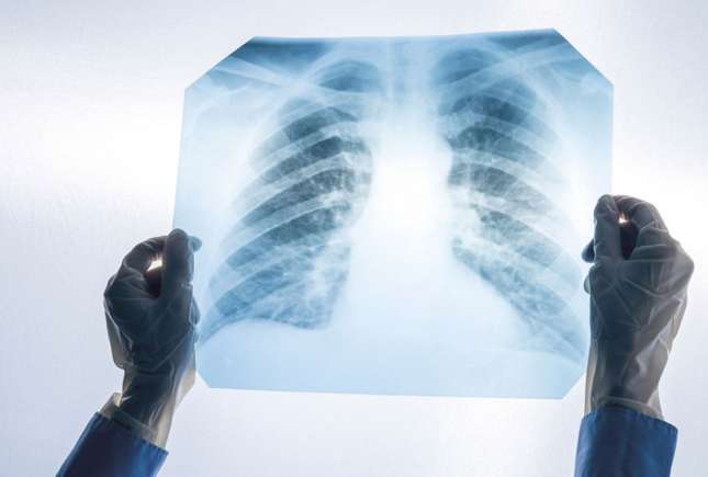 Screening pulmonar gratuit la Chișinău, pe 19 și 20 octombrie