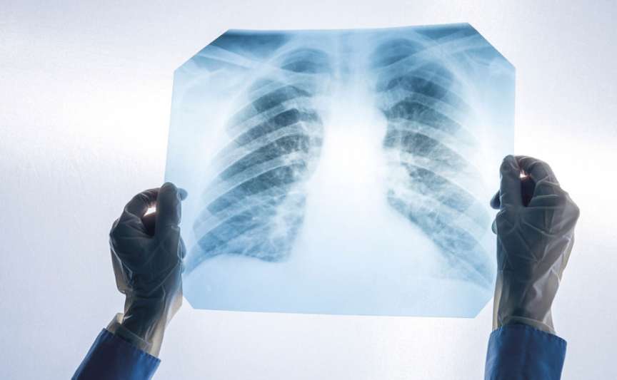 Screening pulmonar gratuit la Chișinău, pe 19 și 20 octombrie